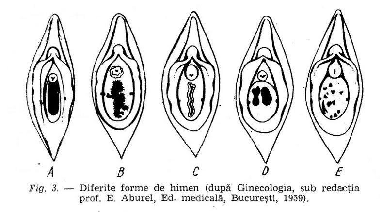 diferite forme de himen